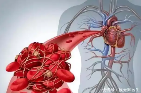 膽固醇升高身體遭殃？教你4招，擊退高血脂，平穩(wěn)膽固醇